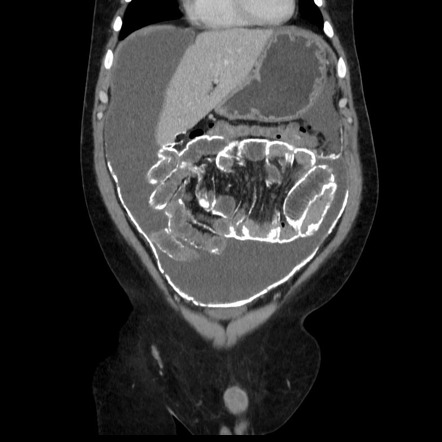 Encapsulating Peritoneal Sclerosis 