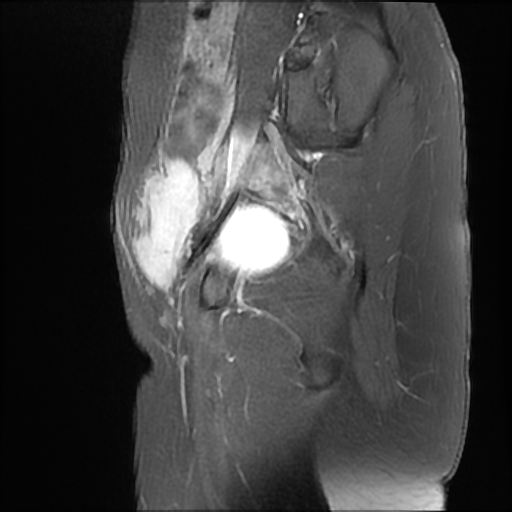 Desmoid Tumor Abdominal Wall Image 8113