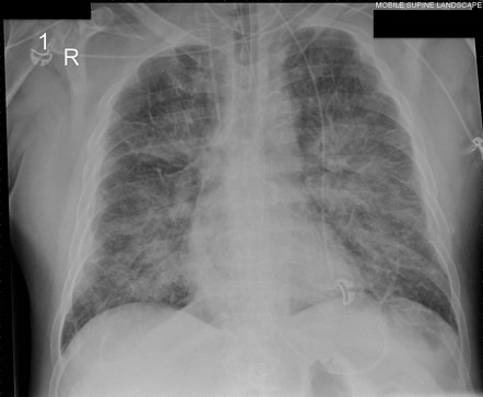 Pulmonary Edema | Radiology Reference Article | Radiopaedia.org