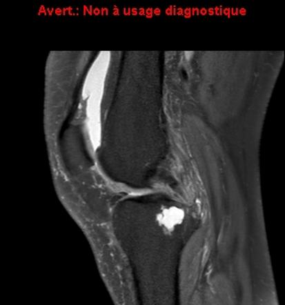 Radiological Appearance Of An Intraosseous Ganglion C - vrogue.co