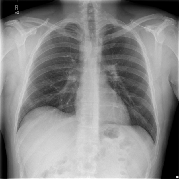 Right-sided aortic arch | Image | Radiopaedia.org