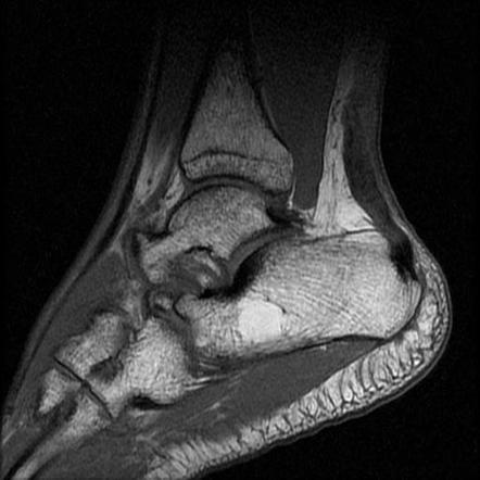 Traumatic Achilles tendon tear | Image | Radiopaedia.org