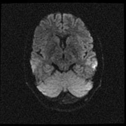 Mega cisterna magna | Image | Radiopaedia.org