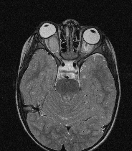 optic-nerve-glioma-image-radiopaedia