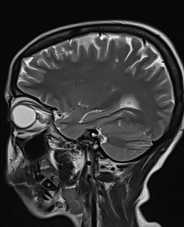 Staphyloma | Image | Radiopaedia.org