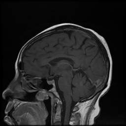 Dislocation of the inferior turbinate | Image | Radiopaedia.org