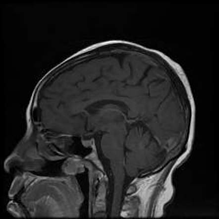 Dislocation Of The Inferior Turbinate 