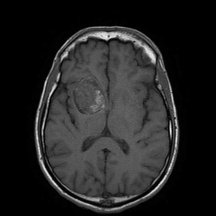 Cerebral cavernous malformation | Radiology Case | Radiopaedia.org