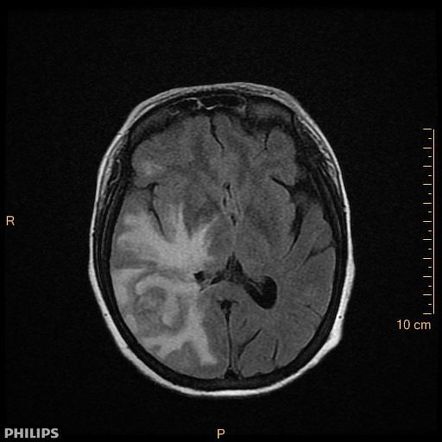 Cerebral Chagas disease | Image | Radiopaedia.org