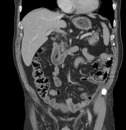 Duodenal lipoma | Radiology Case | Radiopaedia.org