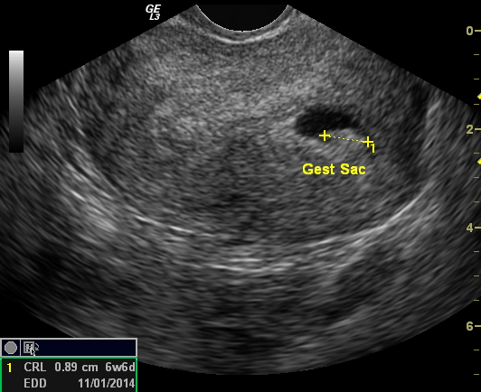 Bicornuate Uterus | Image | Radiopaedia.org