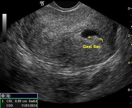 Bicornuate Uterus | Image | Radiopaedia.org