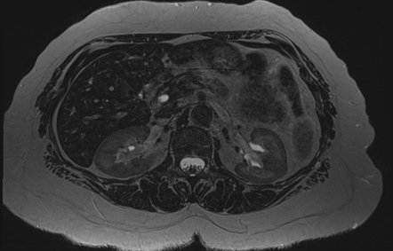 Insulinoma | Image | Radiopaedia.org