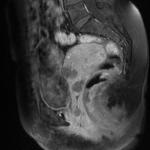 Adenoma Malignum Of Cervix Image Radiopaedia Org