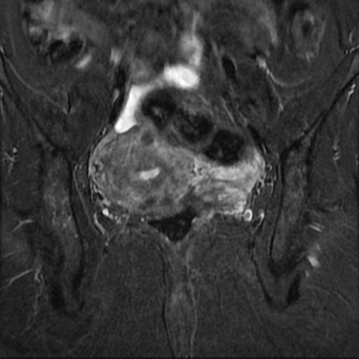 Adenoma malignum of cervix | Image | Radiopaedia.org