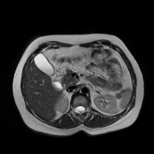 Adenoma malignum of cervix | Image | Radiopaedia.org