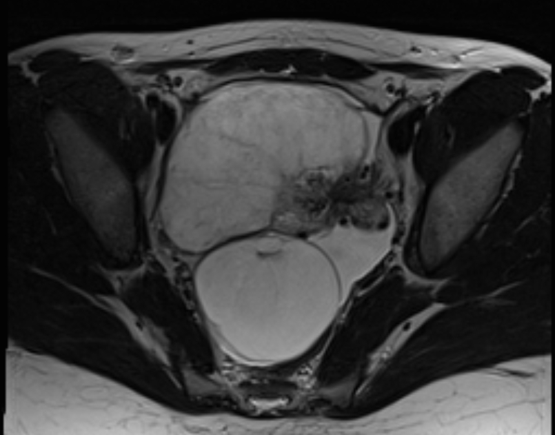 ovarian-torsion-image-radiopaedia