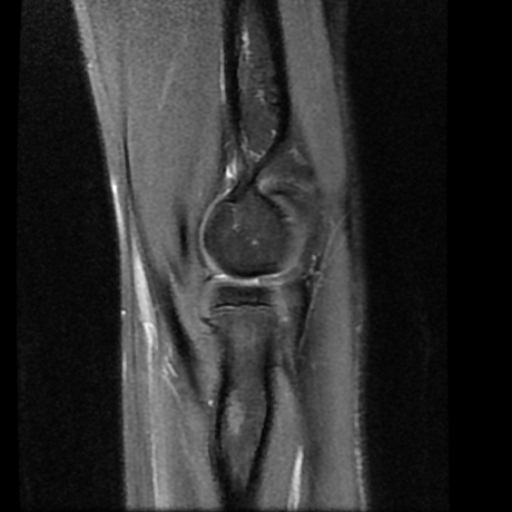 Intramuscular ganglion cyst of elbow | Image | Radiopaedia.org