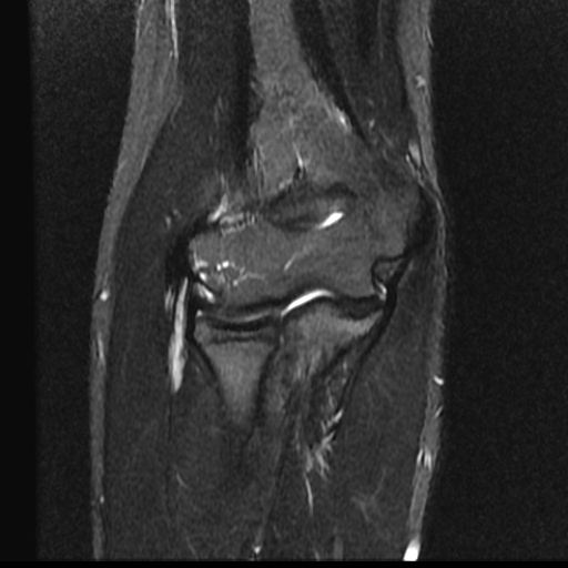 Intramuscular ganglion cyst of elbow | Image | Radiopaedia.org