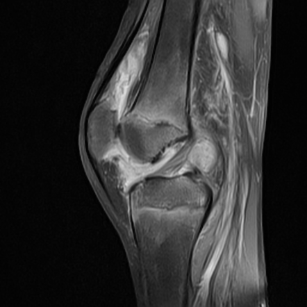 Synovitis - knee | Image | Radiopaedia.org