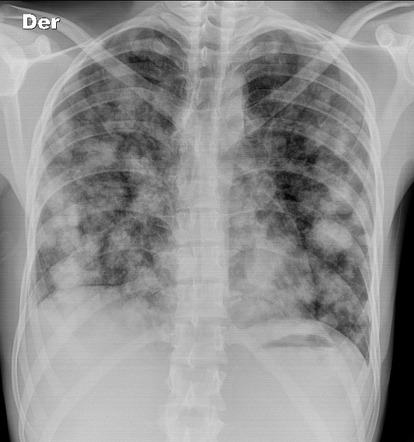 Pulmonary metastases | Radiology Reference Article | Radiopaedia.org