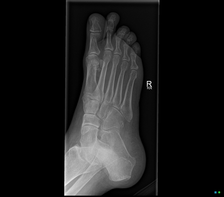 Multipartite hallux sesamoid | Radiology Reference Article