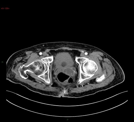 Seminal vesicle abscess | Radiology Case | Radiopaedia.org