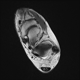 Subtendinous marrow edema - peroneus longus | Image | Radiopaedia.org