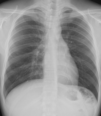 Anterior junctional line | Radiology Case | Radiopaedia.org