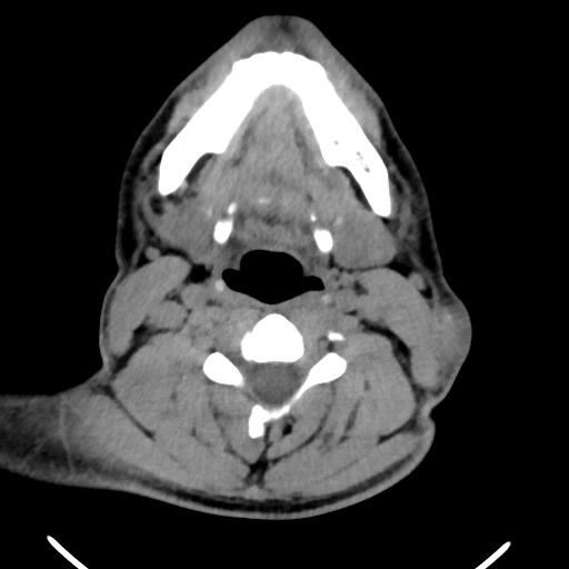 Pilomatricoma | Image | Radiopaedia.org