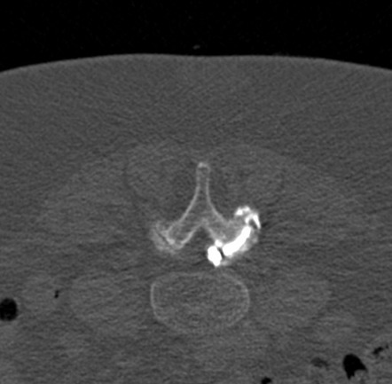 CT-guided Percutaneous Rupture Of Lumbar Facet Joint Cyst | Image ...