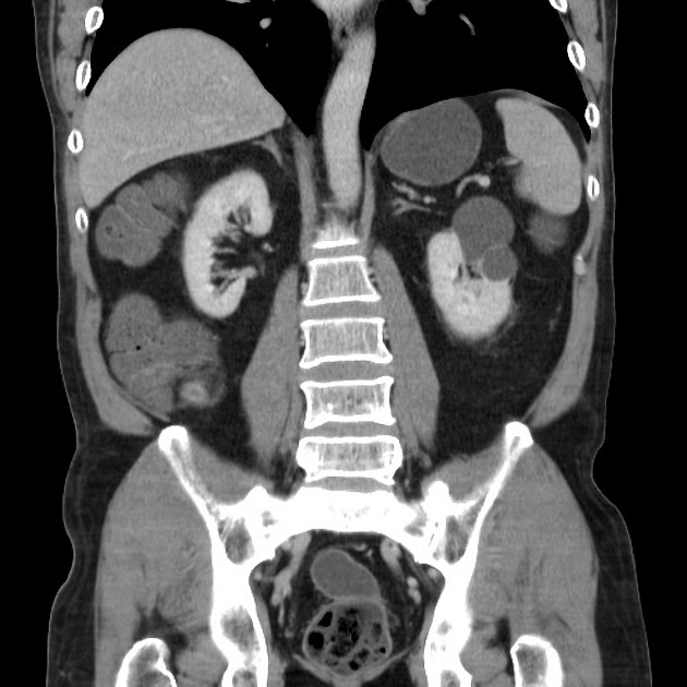 Featured image of post Appendicitis Ct Radiopaedia Appendicitis is inflammation of the appendix