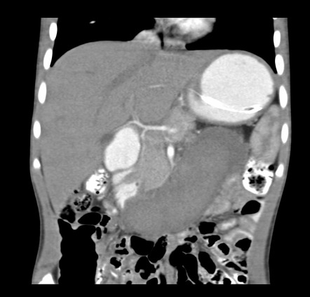 Duodenal hematoma | Radiology Reference Article | Radiopaedia.org