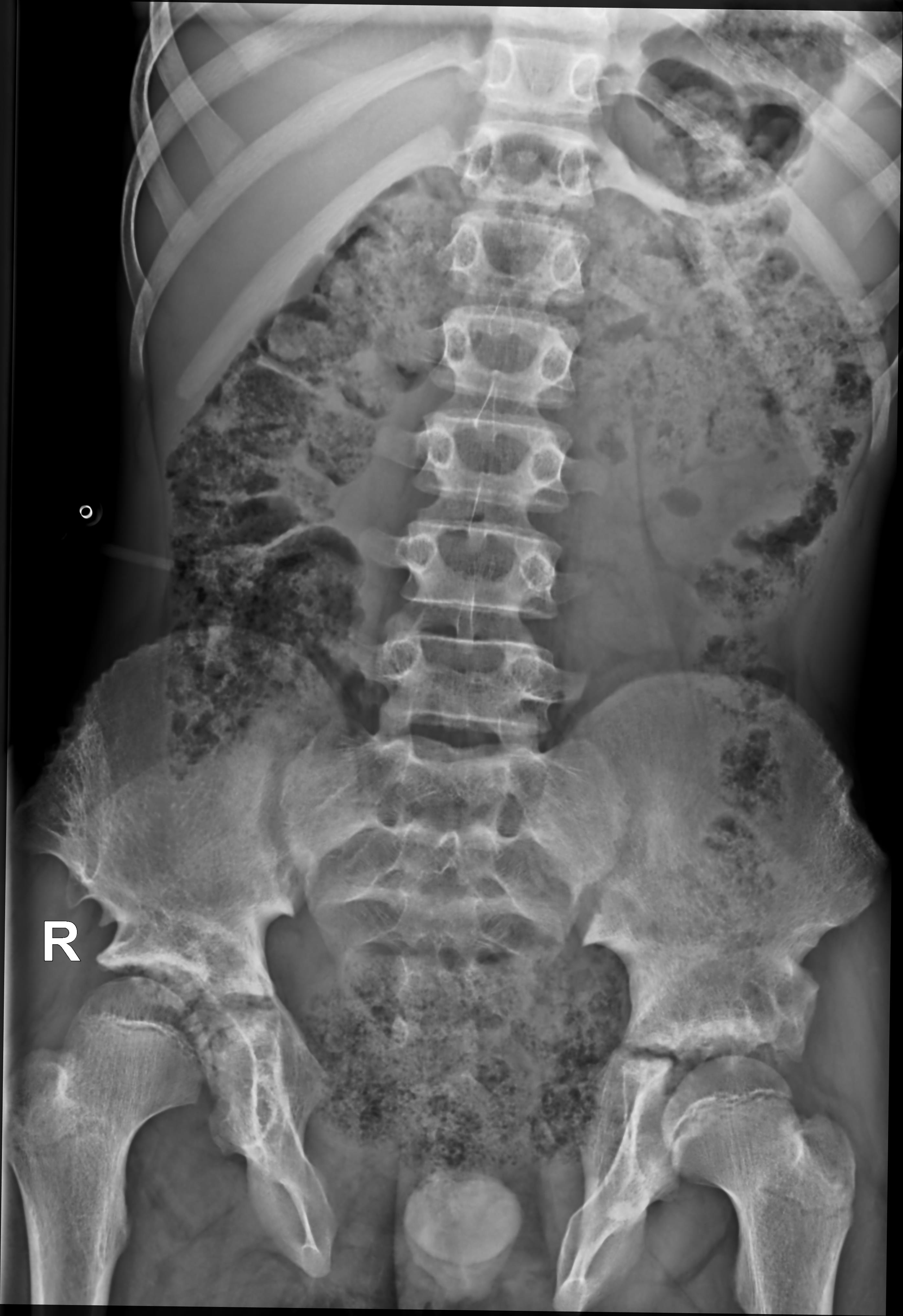 Bladder exstrophy and ileal conduit | Image | Radiopaedia.org