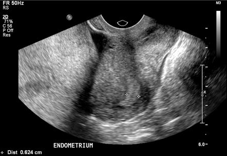 Metachronous ovarian dysgerminomas | Radiology Case | Radiopaedia.org