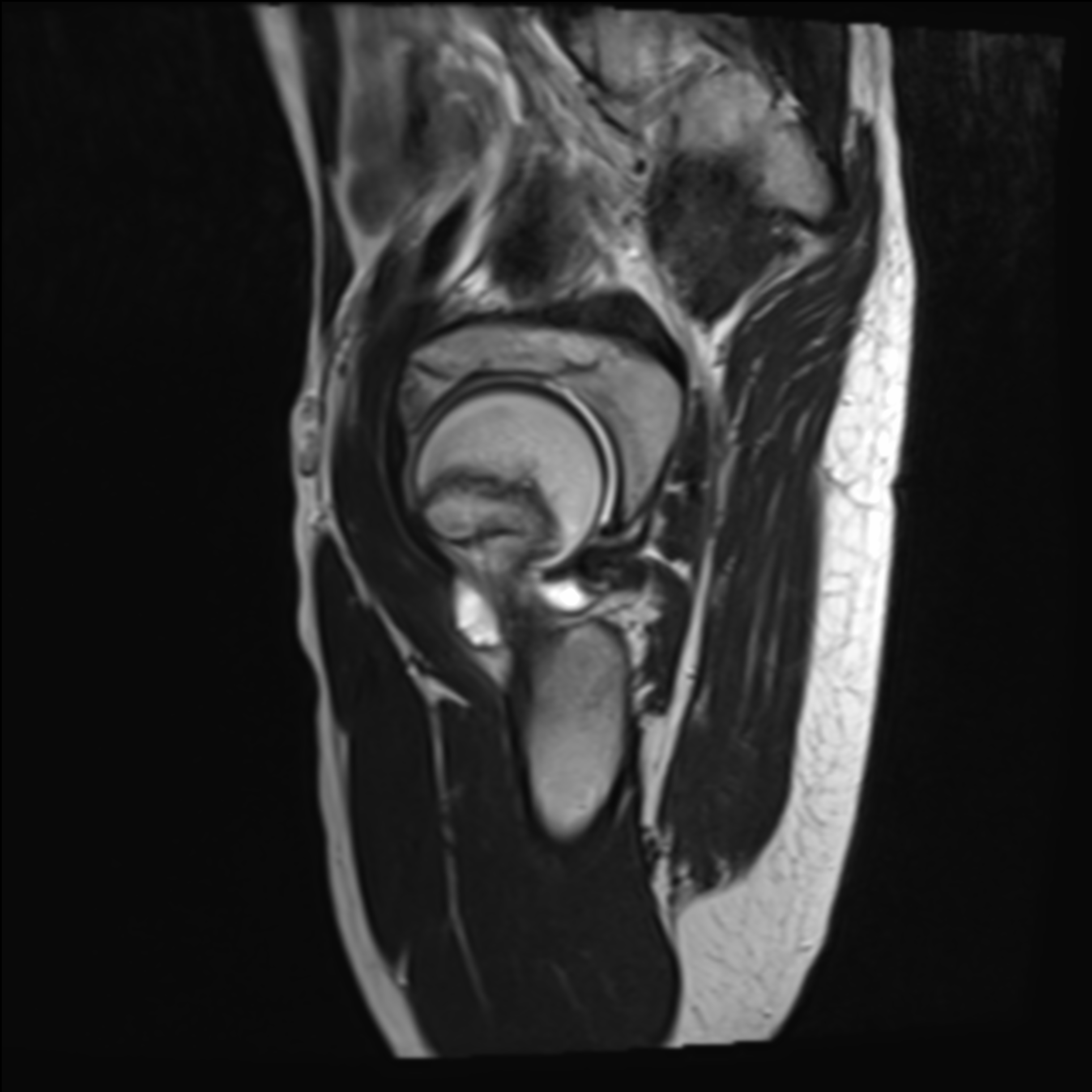 Slipped Capital Femoral Epiphysis Scfe Image 2425