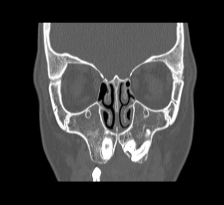 Paranasal Sinus Total Aplasia 