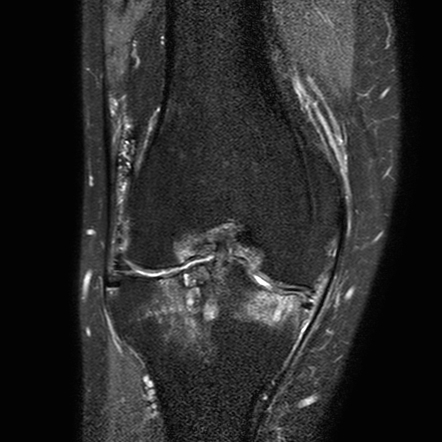 Haemophilic arthropathy | Image | Radiopaedia.org