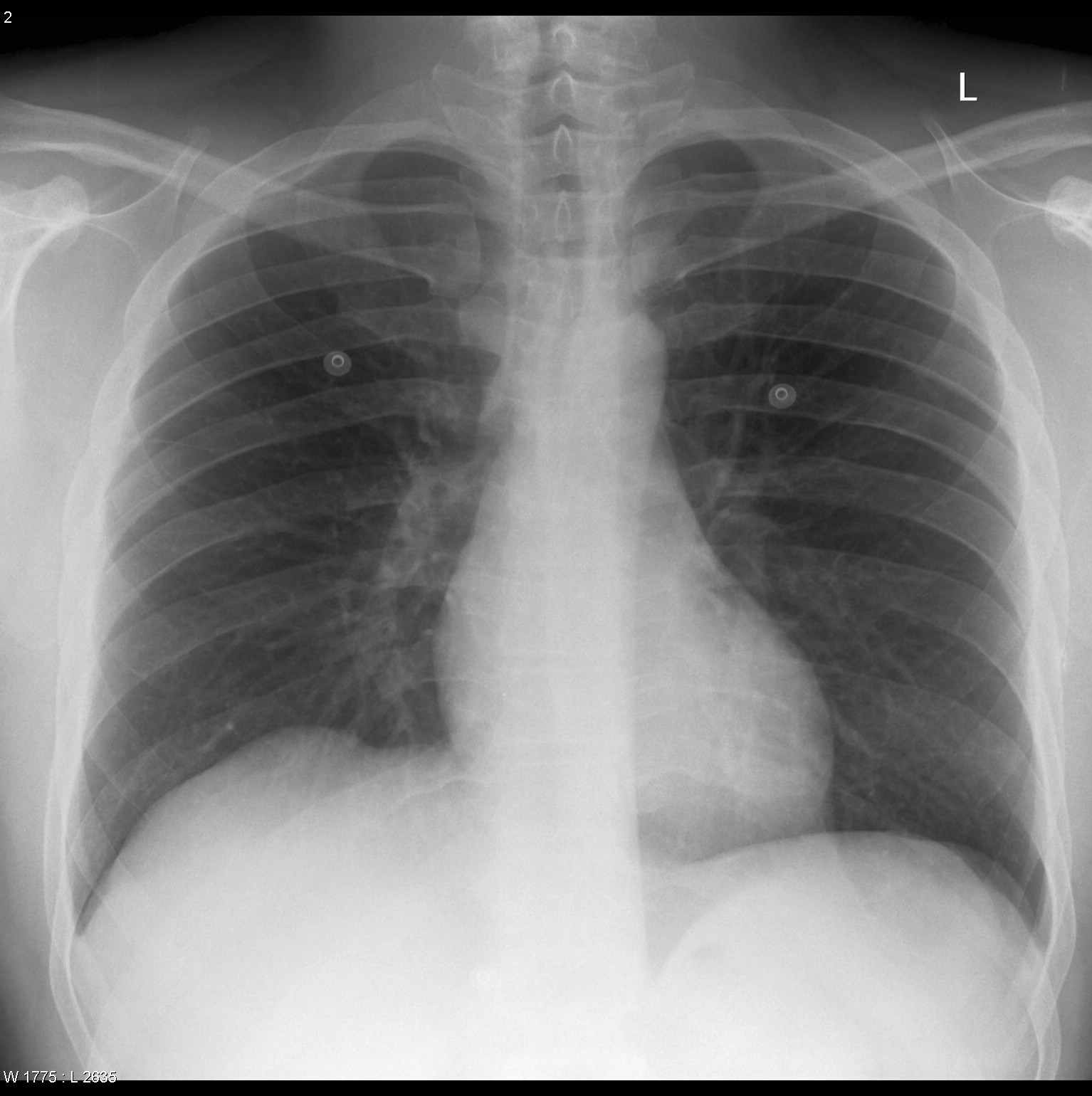 Pneumomediastinum | Image | Radiopaedia.org