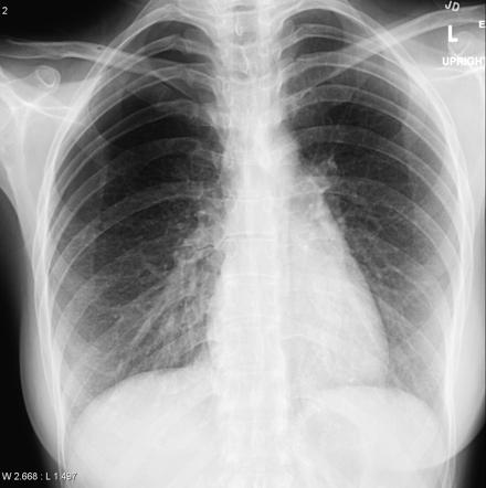 Catamenial pneumothorax | Image | Radiopaedia.org