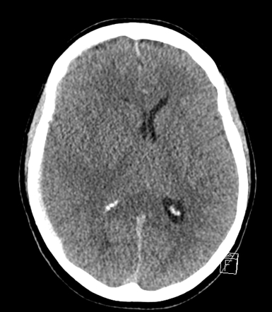 Right mesial temporal lobe jet hematoma from ruptured PCom artery ...