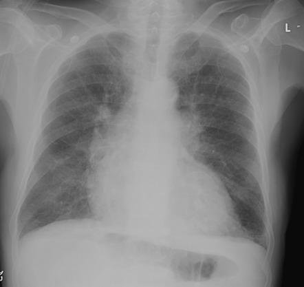 Calcified left ventricular mural thrombus | Radiology Case ...