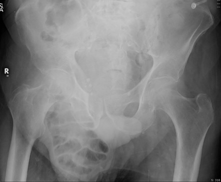 Large right inguinal hernia - pelvic x-ray | Radiology Case ...