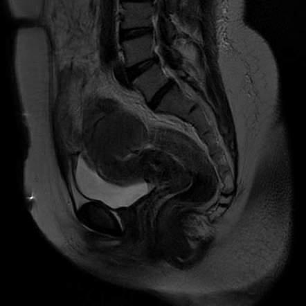 Ovarian endometriomas - shading sign | Image | Radiopaedia.org