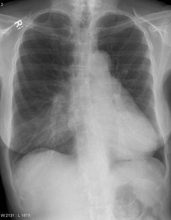 Pectus excavatum | Image | Radiopaedia.org