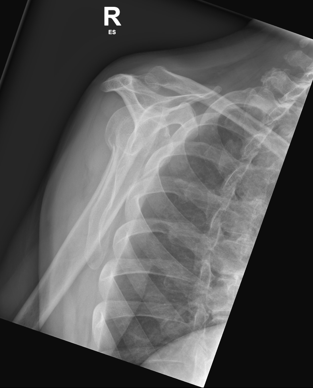 Anatomical Neck Fracture Humerus