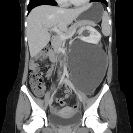 Iatrogenic Urinoma 