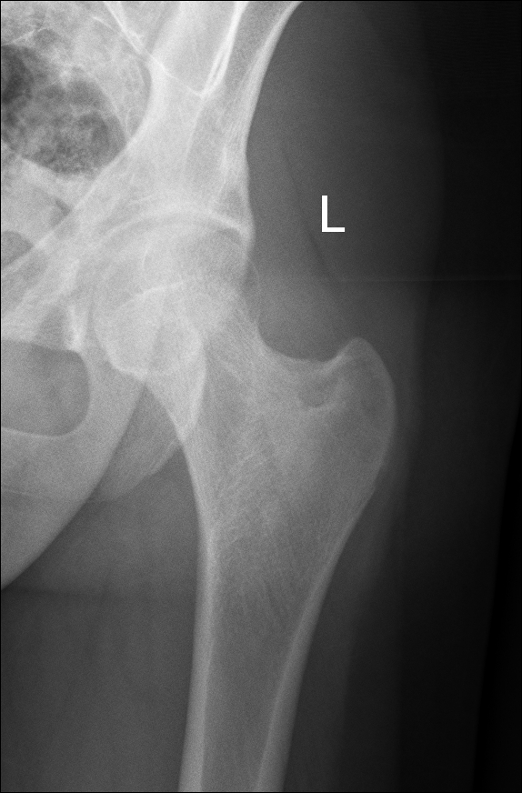 Ankylosing spondylitis presenting as gluteal enthesitis | Image ...