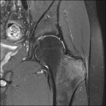 Viewing playlist: MRI hip | Radiopaedia.org