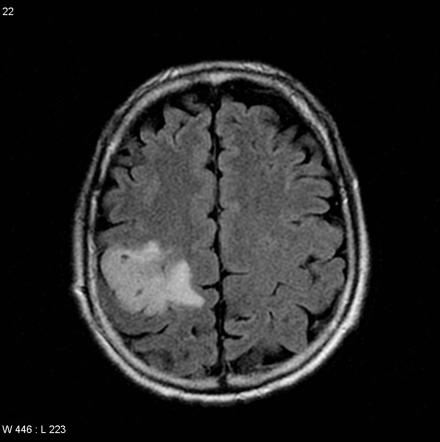 Oligodendroglioma Nos 